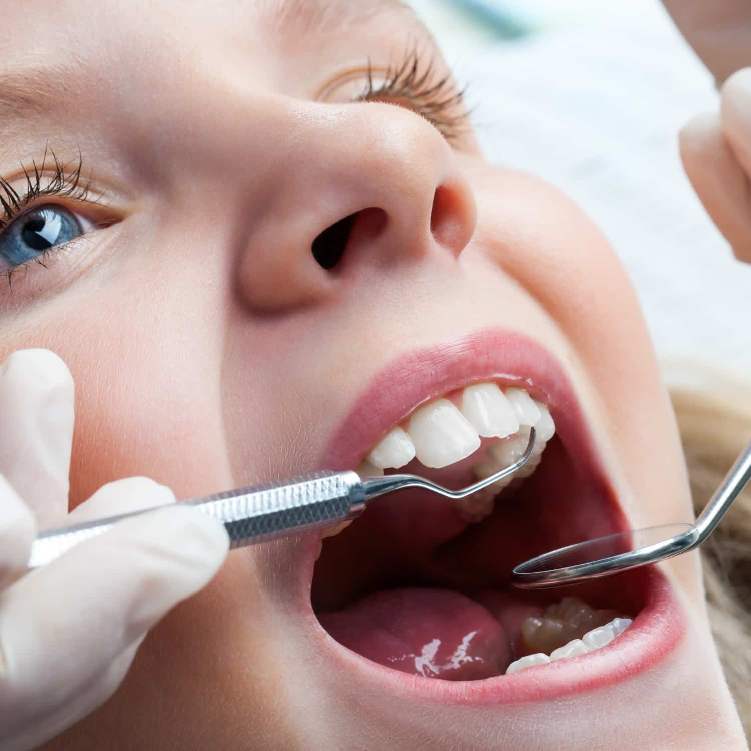 Little girl getting a dental sealant in Griffin GA